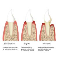 gingivits &amp; parodontitis